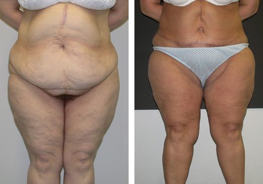 Patient-00552710dd0d8087 - Thigh Lifts Before and After | Fairfax and Manassas VA
