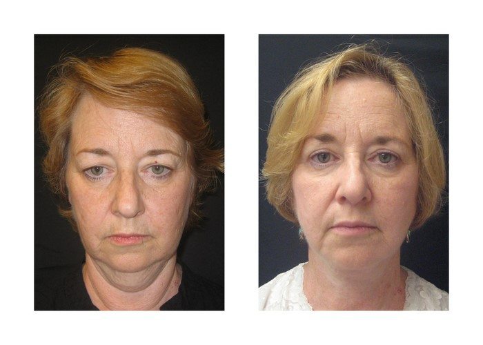 Patient 011 - Neck Lift Before and After | Fairfax and Manassas VA