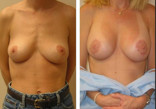 Patient004a - Breast Lift Augmentation Before And After - Fairfax and Manassas VA