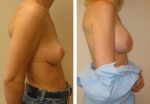 Patient004b - Breast Lift Augmentation Before And After - Fairfax and Manassas VA