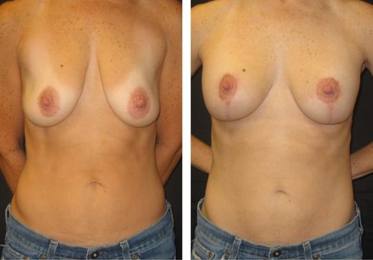 Patient009a - Breast Lift Augmentation Before And After - Fairfax and Manassas VA