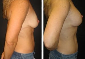 Patient009b - Breast Lift Augmentation Before And After - Fairfax and Manassas VA