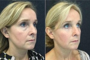 R 45 -24134 - Eyelid Lift Before and After | Fairfax and Manassas VA