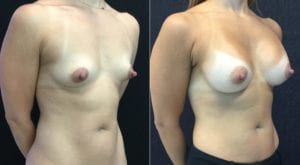 R ANGLE-21926- - Breast Augmentation Before And After - Fairfax and Manassas VA