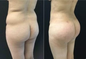 Before & After - Brazilian Butt Lift Angled - Bitar Cosmetic Institute | Fairfax and Manassas VA