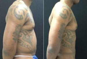 R PROFILE-21164- - Abdominal Etching Before and After | Fairfax and Manassas VA