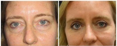 admin-ajax - Upper and Lower Eyelid Lift - Before and After - Bitar Cosmetic Institute | Fairfax and Manassas VA