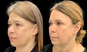eyelid-lift-upper-lower-before-and-after-56-yr-old-female-left-quarter-view-10781 - 