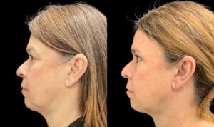 eyelid-lift-upper-lower-before-and-after-56-yr-old-female-left-side-view-10781 - 