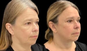 eyelid-lift-upper-lower-before-and-after-56-yr-old-female-right-quarter-view-10781 - 