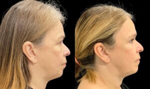 eyelid-lift-upper-lower-before-and-after-56-yr-old-female-right-side-view-10781 - 