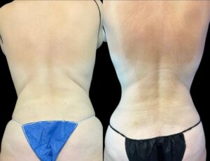 female before and after coolsculpting elite back