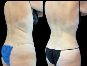 female before and after coolsculpting elite back sideview