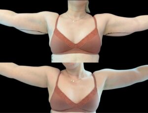 female before and after Coolsculpting underarms