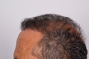 hair_transplant_photo_6_months_after_procedure