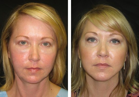 liquid-1527114f28fc05-non-surgical-facelift - Non-Surgical Cheek Augmentation - Before And After | Fairfax and Manassas VA