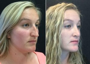 r angle-20826 - Rhinoplasty for Women Before and After | Fairfax and Manassas VA