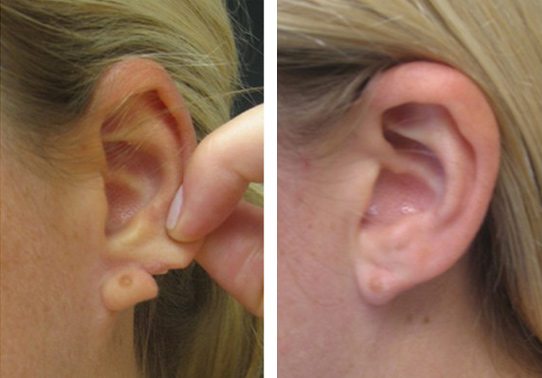 1-torn-earlobe-repair - Torn Earlobe Repair - Before And After | Fairfax and Manassas VA