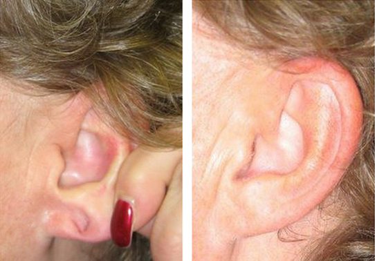 10-torn-earlobe-repair - Torn Earlobe Repair - Before And After | Fairfax and Manassas VA