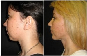 10120-neck-liposuction - Neck Liposuction - Before And After | Fairfax and Manassas VA
