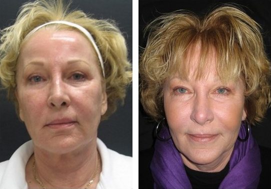 10210-frontview527114ef198e7-non-surgical-facelift - Non-Surgical Facelift - Patient 7 - Before & After 1 | Fairfax and Manassas, VA