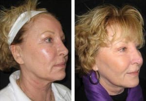 10210-sideview-non-surgical-facelift - Non-Surgical Facelift - Before And After | Fairfax and Manassas VA