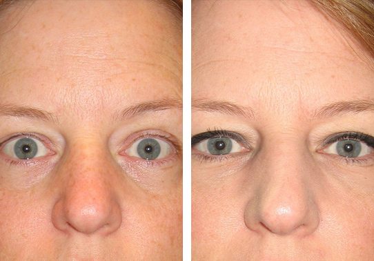 10228-eyes-frontview-restylane - Restylane - Before And After | Fairfax and Manassas VA