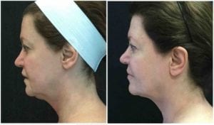 Ultherapy Lift - Before And After | Fairfax and Manassas VA