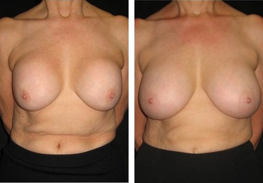 10311-front-breast-implant-exchange - Breast Implant Exchange - Before And After - Fairfax and Manassas VA