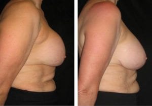 10311-side-breast-implant-exchange - Breast Implant Exchange - Before And After - Fairfax and Manassas VA