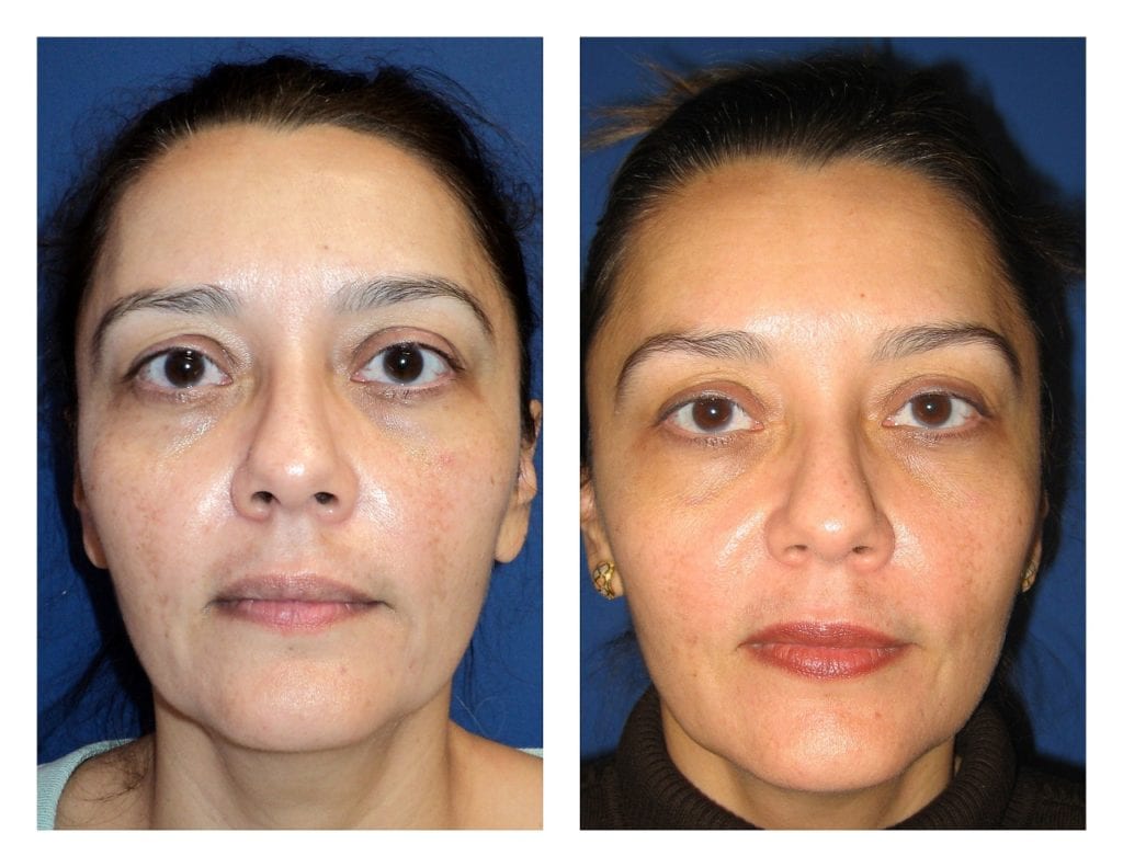 10581-skin-care - Skin Care Peels - Before And After | Fairfax and Manassas VA