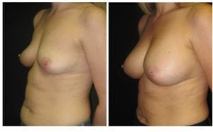 10626b1-breast-augmentation - Breast Augmentation Before And After - Fairfax and Manassas VA