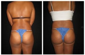 Brazilian Butt Lift - Before And After - Fairfax and Manassas VA