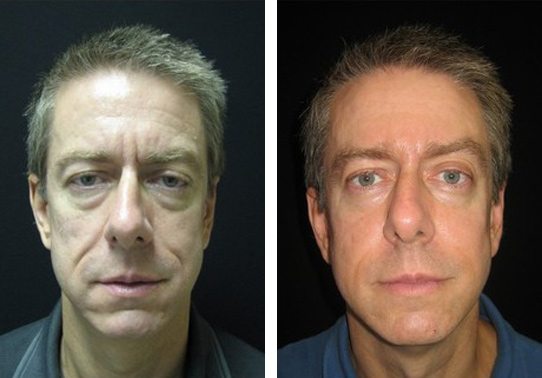 10847-front-non-surgical-facelift - Non-Surgical Facelift - Before And After | Fairfax and Manassas VA