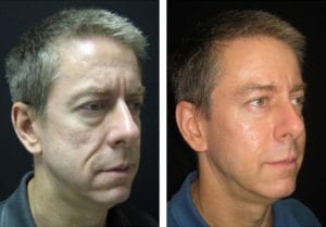 10847-side527114f03006d-non-surgical-facelift - Non-Surgical Facelift - Patient 6 - Before & After 2 | Fairfax and Manassas, VA