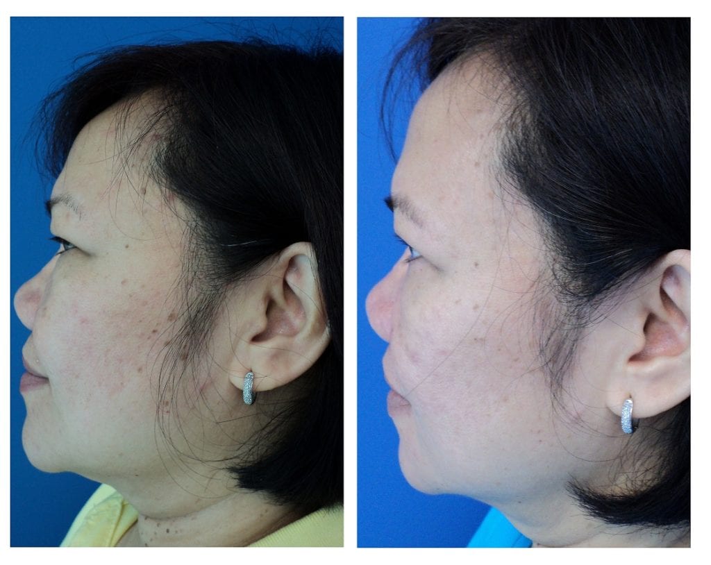 10969-skin-care - Skin Care Peels - Before And After | Fairfax and Manassas VA