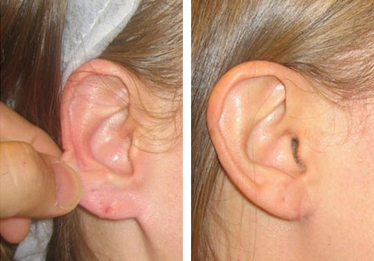 11-torn-earlobe-repair - Torn Earlobe Repair - Before And After | Fairfax and Manassas VA