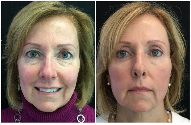 11168a-eyelid-lift-upper-and-lower - Upper and Lower Eyelid Lift - Before And After - Fairfax and Manassas VA