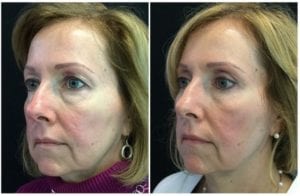 11168b-eyelid-lift-upper-and-lower - Upper and Lower Eyelid Lift - Before And After - Fairfax and Manassas VA
