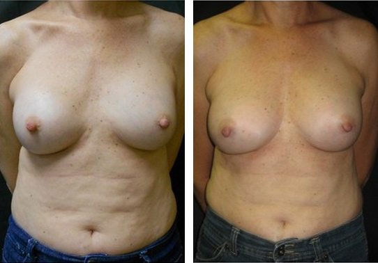 11336-front-breast-implant-exchange - Breast Implant Exchange - Before And After - Fairfax and Manassas VA