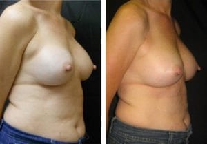 11336-side-breast-implant-exchange - Breast Implant Exchange - Before And After - Fairfax and Manassas VA
