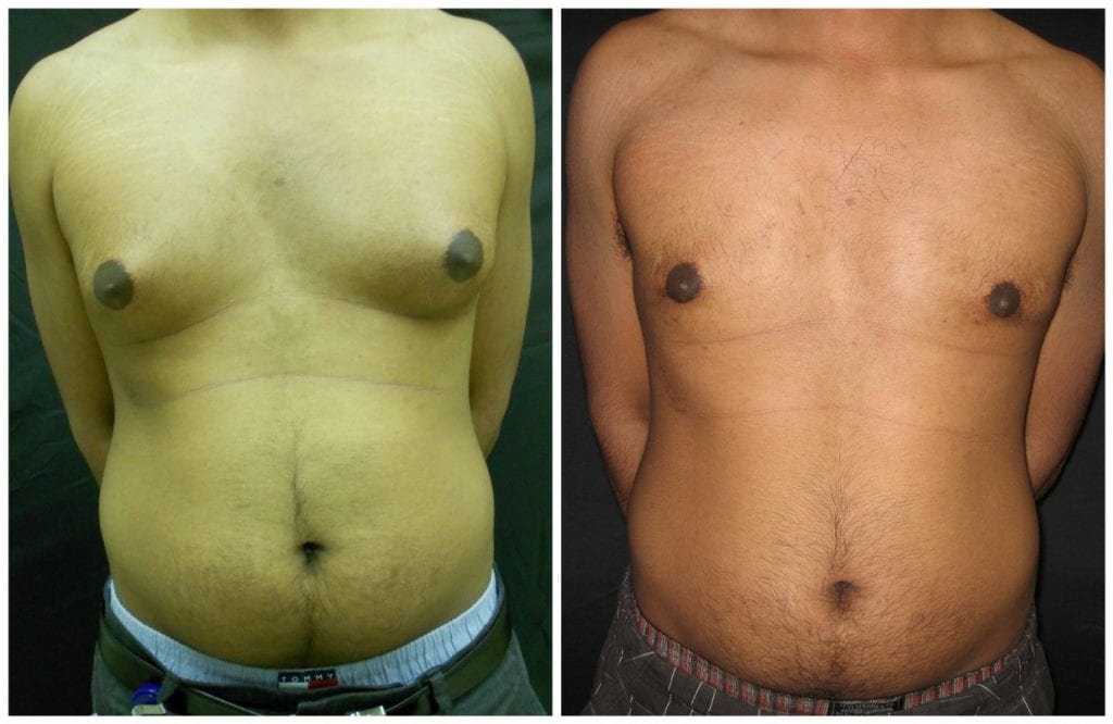 11753a-male-breast-reduction - Male Breast Reduction - Before And After - Gynecomastia - Fairfax and Manassas VA