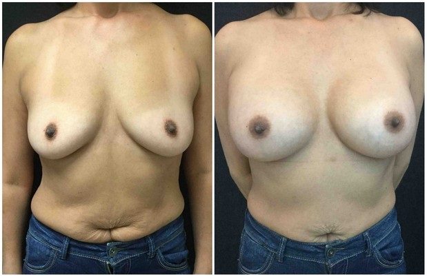 11896a-breast-augmentation - Breast Augmentation Before And After - Fairfax and Manassas VA