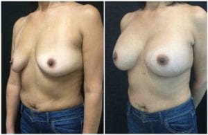 11896b-breast-augmentation - Breast Augmentation Before And After - Fairfax and Manassas VA