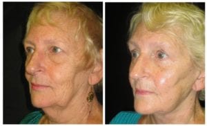 12060b-facelift - Facelift - Before And After Photos - Fairfax and Manassas VA