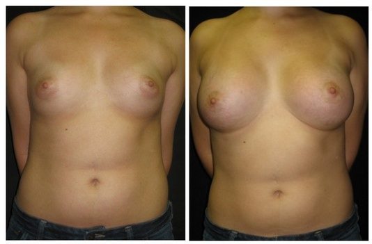 12071-front-breast-augmentation - Breast Augmentation Before And After - Fairfax and Manassas VA