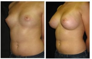 12071-side-breast-augmentation - Breast Augmentation Before And After - Fairfax and Manassas VA