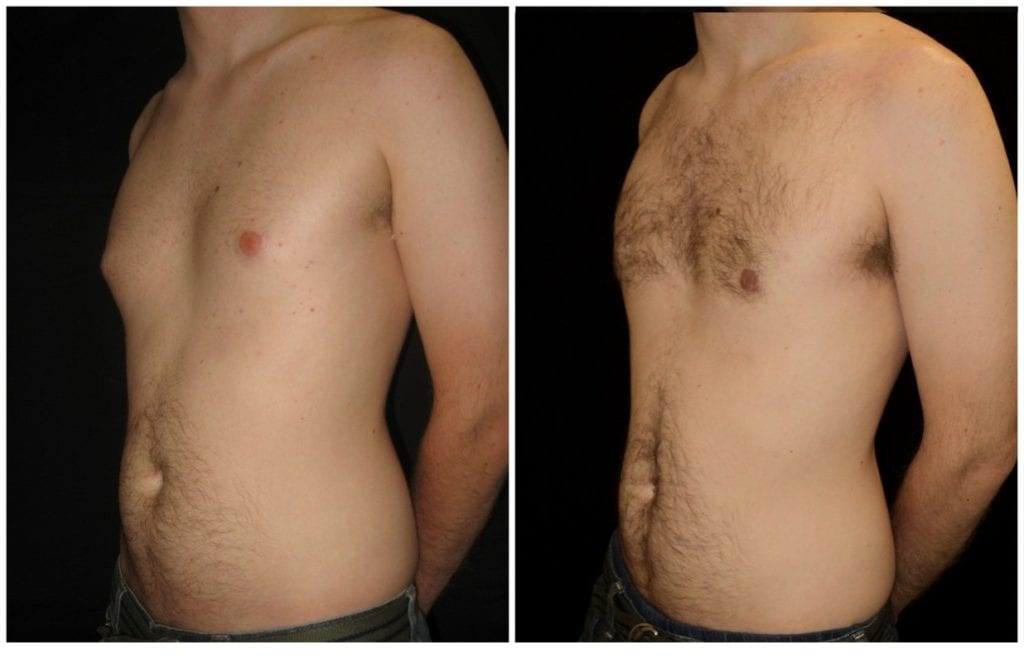 12097a-male-breast-reduction - Male Breast Reduction - Before And After - Gynecomastia - Fairfax and Manassas VA