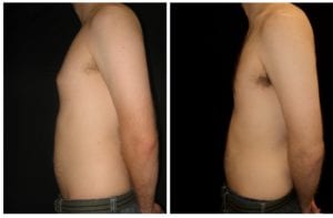 12097b-male-breast-reduction - Male Breast Reduction - Before And After - Gynecomastia - Fairfax and Manassas VA