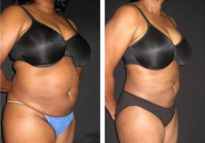 12201-Side-liposuction - Liposuction - Before And After - Fairfax and Manassas VA